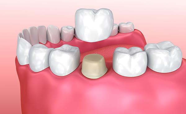 dental-crown-to-restore-damaged-tooth