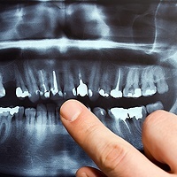 X-Ray-for-full-mouth-reconstruction